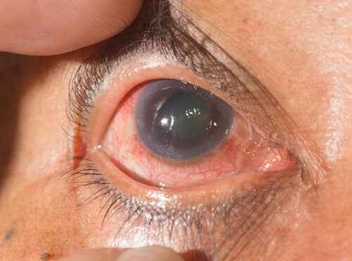 Ayurvedic Treatment for Glaucoma