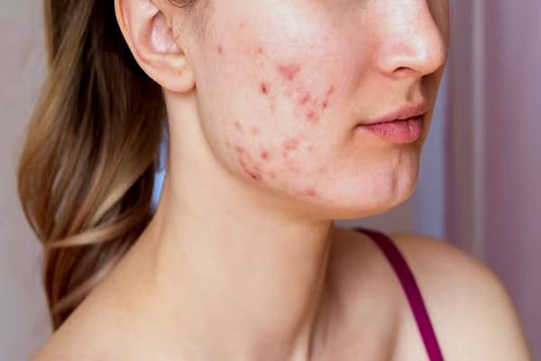 Pimples Treatment In Ayurveda