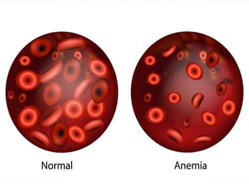 Ayurvedic Treatment for Anemia