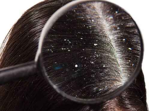 Dandruff Treatment in Ayurveda