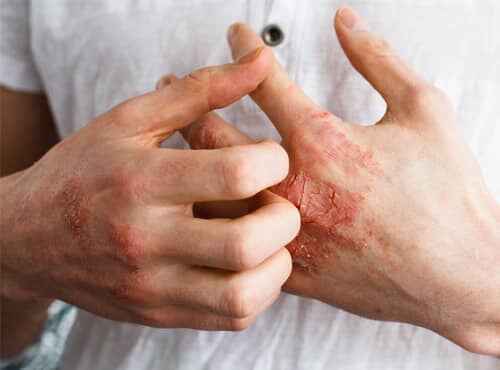 Treatment of Eczema in Ayurveda