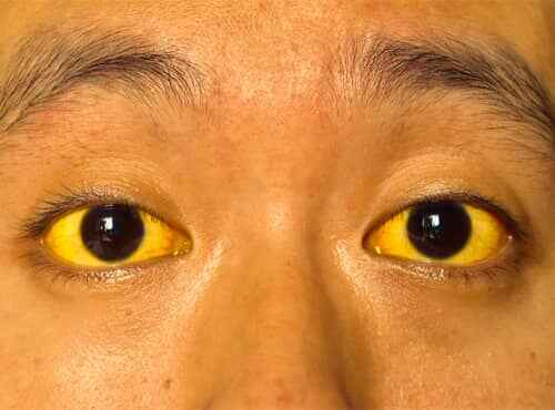 Jaundice Treatment in Ayurveda