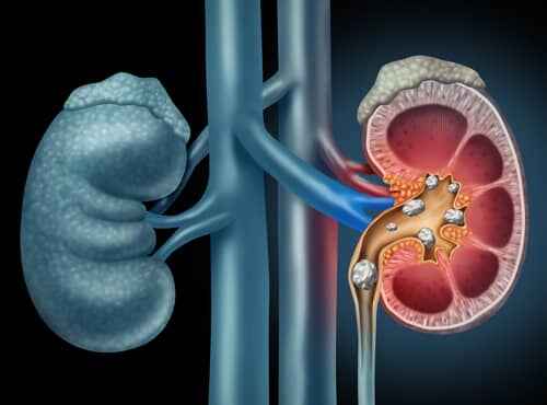 Ayurvedic Treatment for Kidney Stones