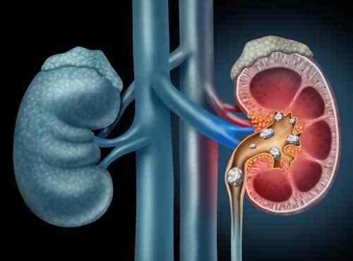 Ayurvedic Treatment for Kidney Stones