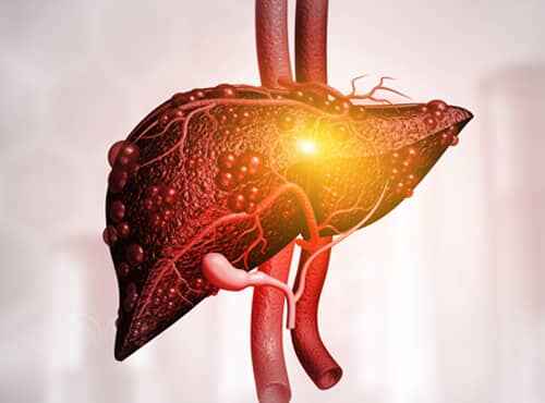 Liver Cirrhosis Treatment in Ayurveda