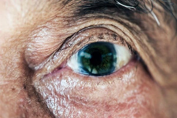 Ayurvedic Treatment for Macular Degeneration