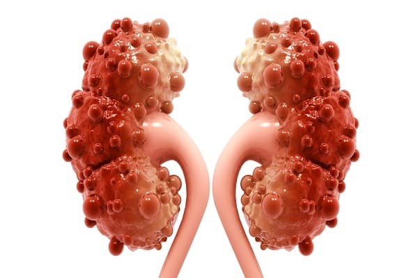 Polycystic Kidney Treatment in ayurveda