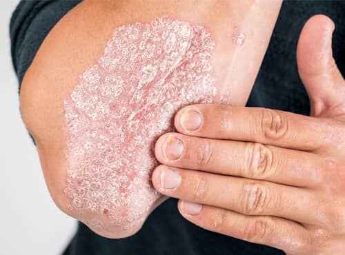 Psoriasis Treatment in Ayurveda