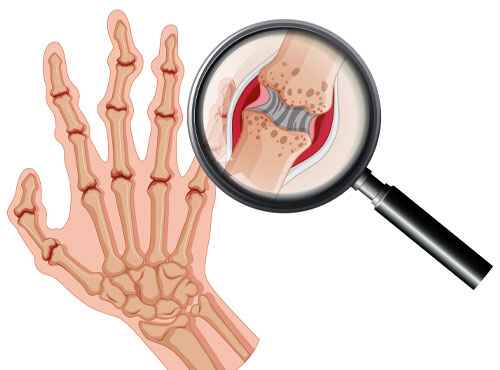 Ayurvedic Treatment For Rheumatoid Arthritis