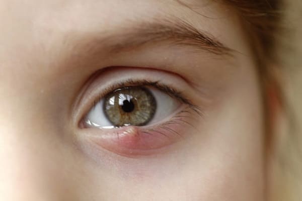 Stye Treatment in Ayurveda