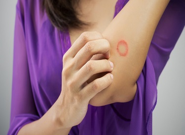 Ringworm treatment in Ayurveda