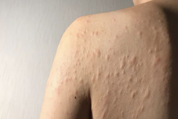 Treatment of Urticaria in Ayurveda