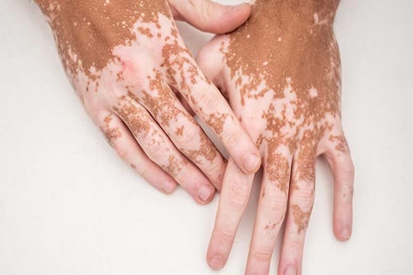 Ayurvedic Treatment for Vitiligo