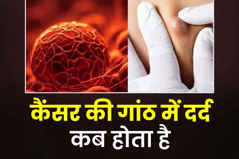 कैंसर की गांठ में दर्द कब होता है 