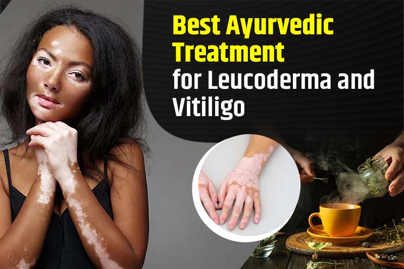 Best Ayurvedic Treatment for Leucoderma and Vitiligo