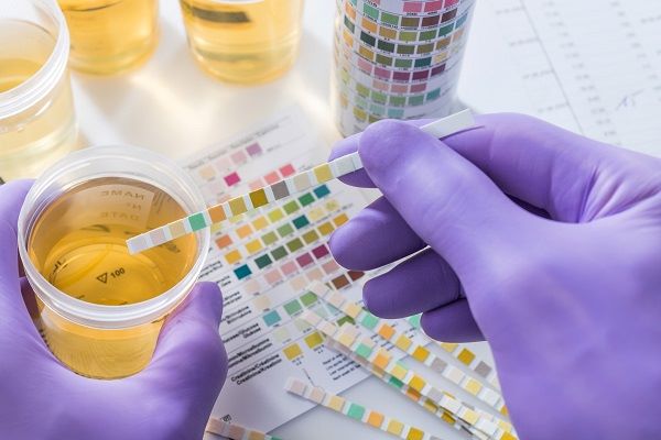 Urine Analysis