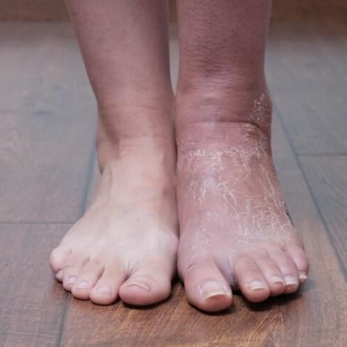 Swelling or Edema