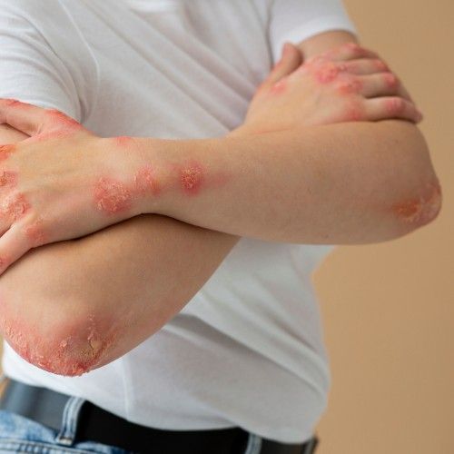 Herpes Ayurvedic Treatment