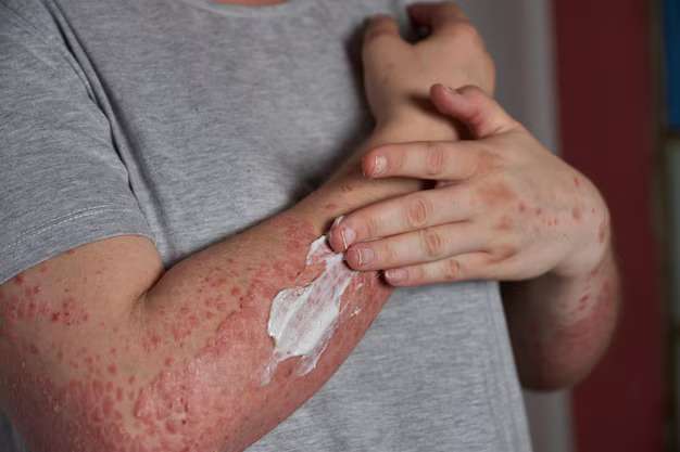 Herpes Ayurvedic Treatment