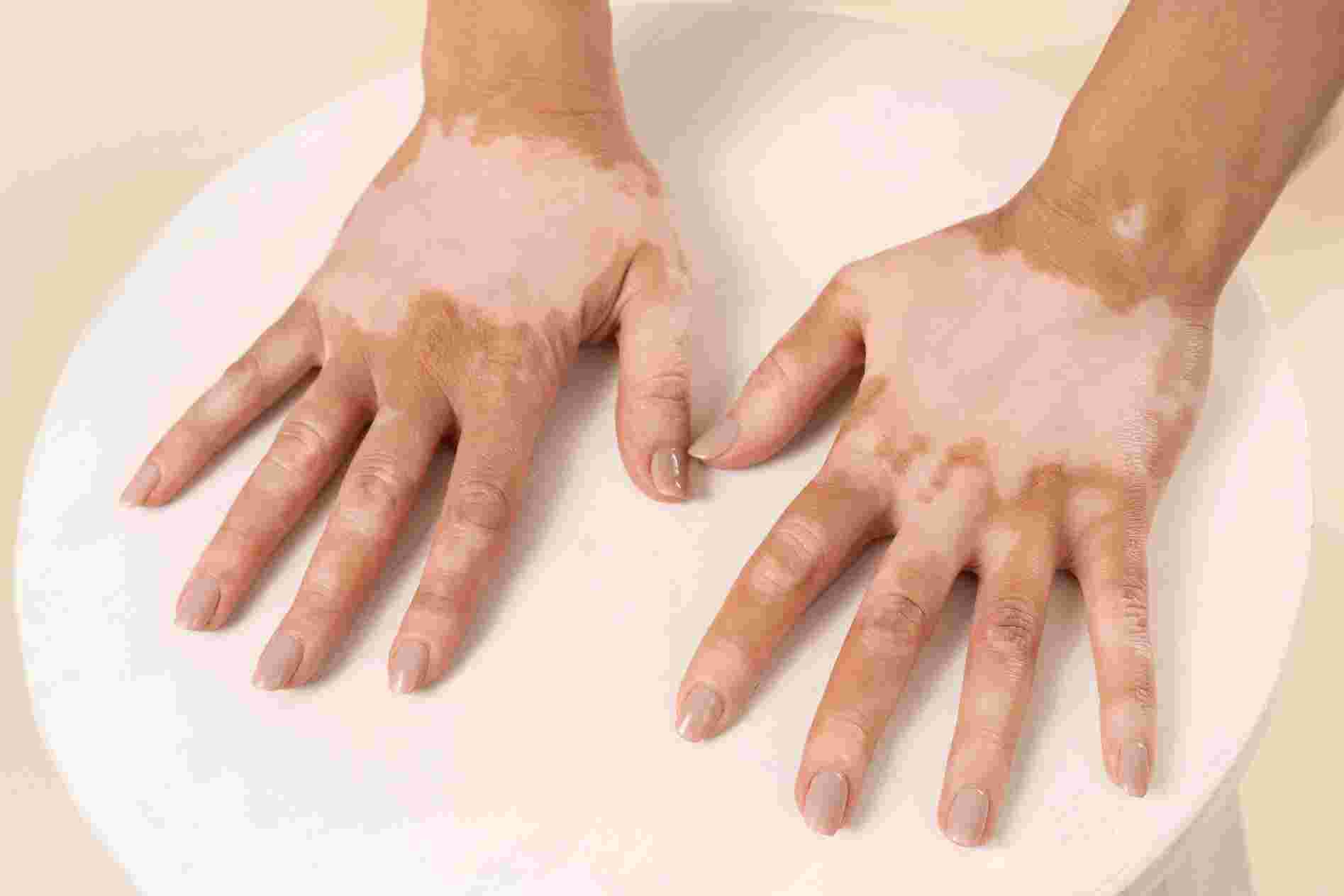 Best Ayurvedic Treatment For Leucoderma And Vitiligo