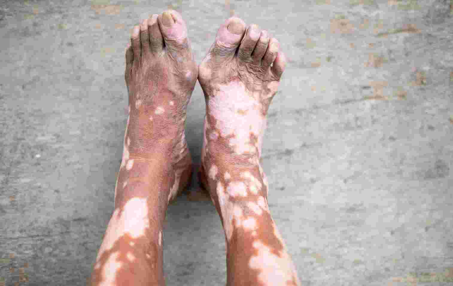 Best Ayurvedic Treatment For Leucoderma And Vitiligo