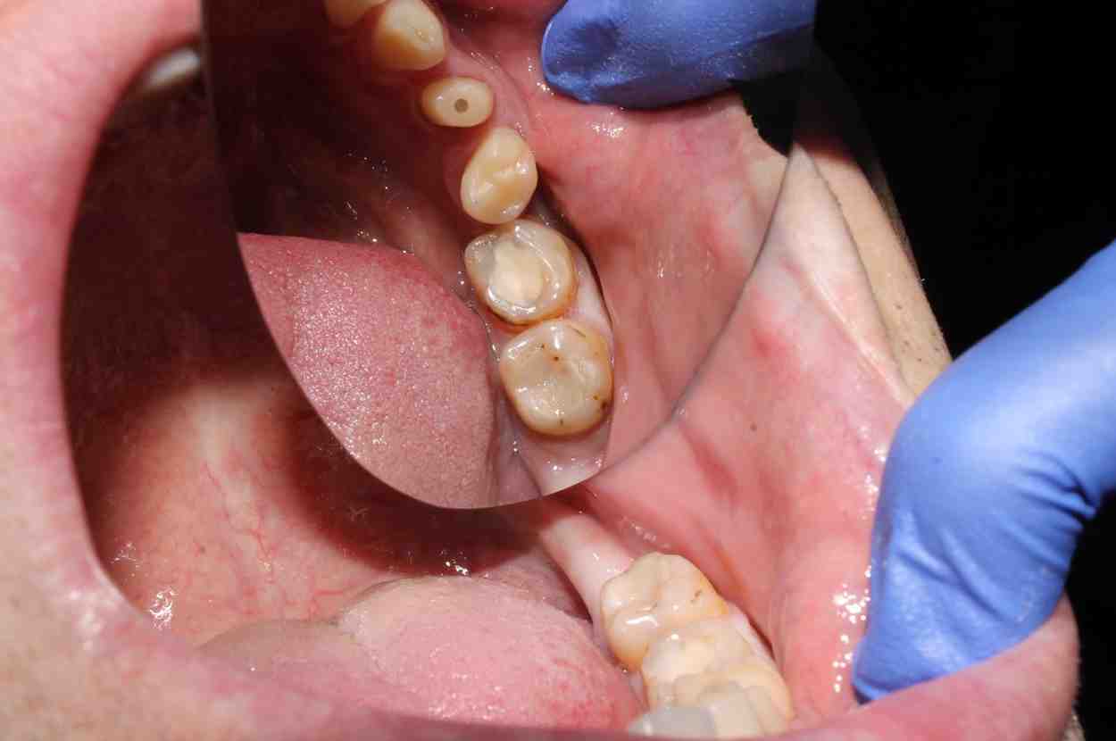 मसूड़ों का कैंसर