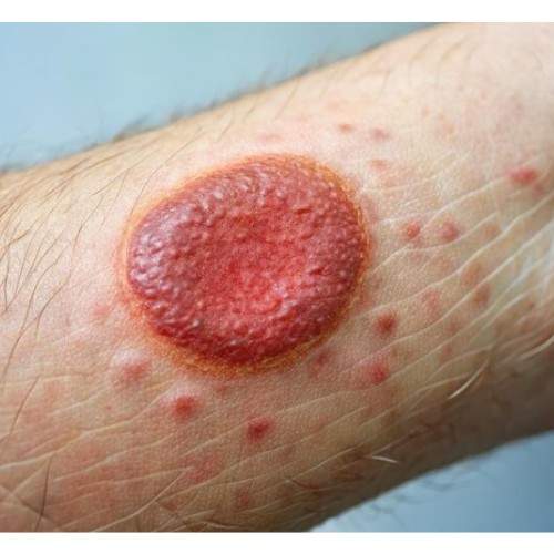 एक्जिमा