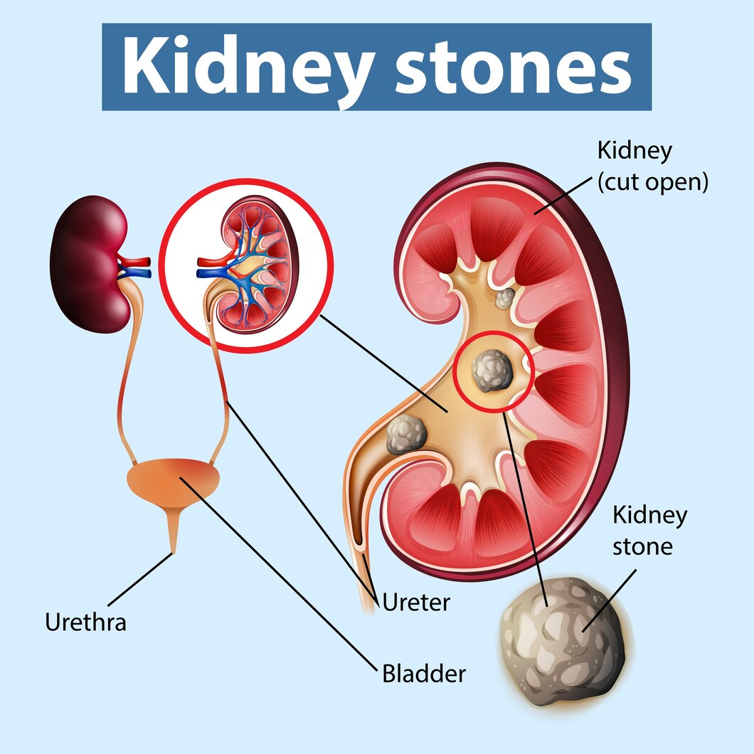 Small Kidney Stone Treatment Without Surgery