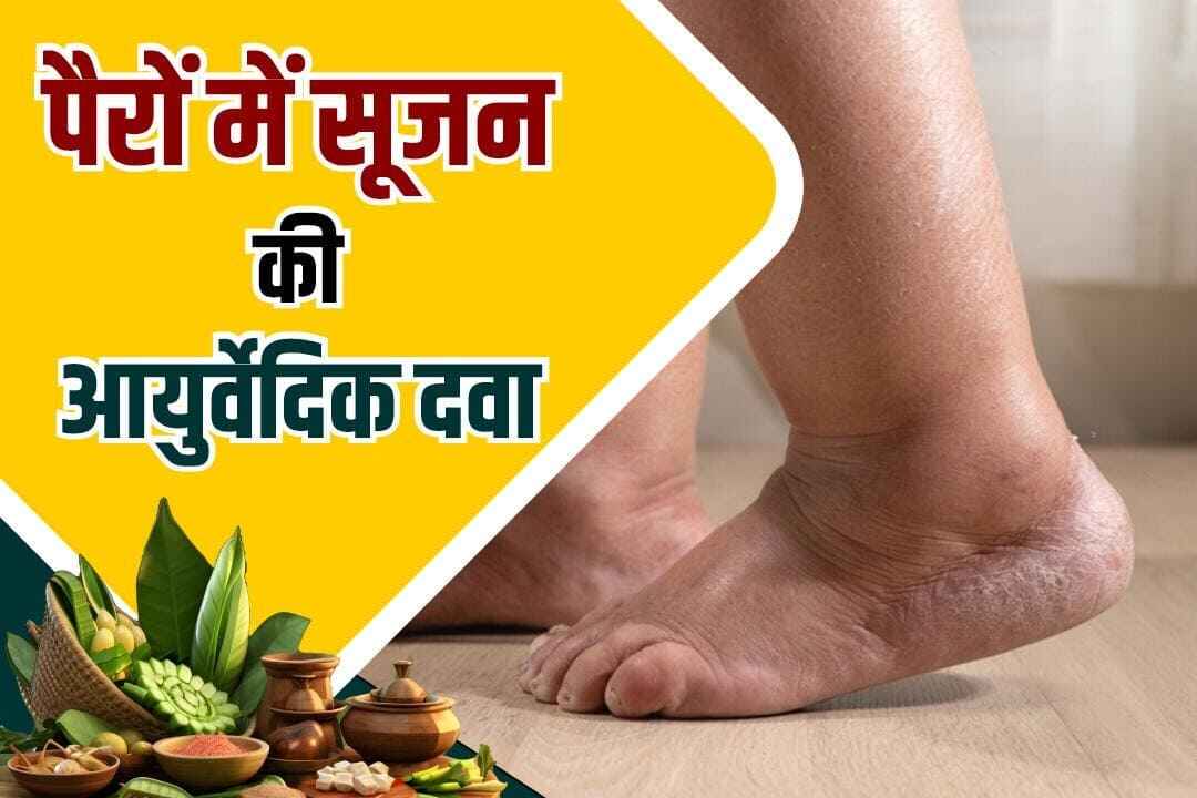 पैरों में सूजन की आयुर्वेदिक दवा