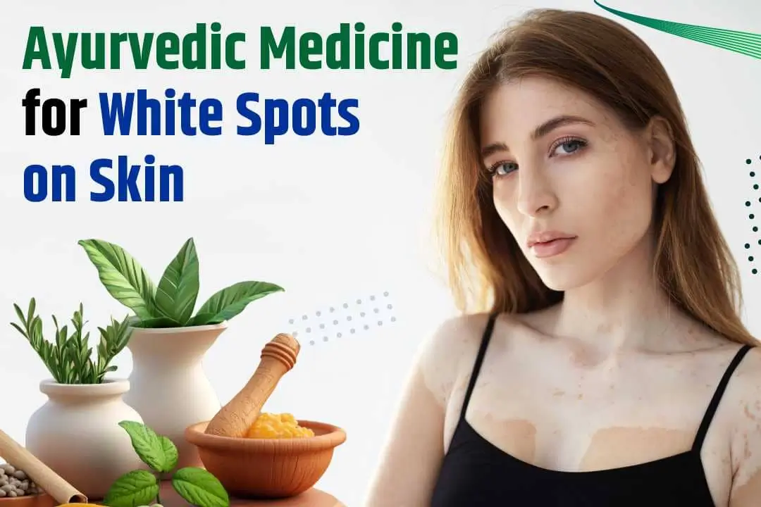 Ayurvedic Medicine for White Spots on Skin