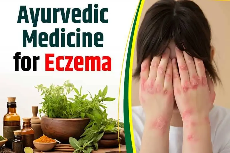 Best Ayurvedic Medicine For Eczema