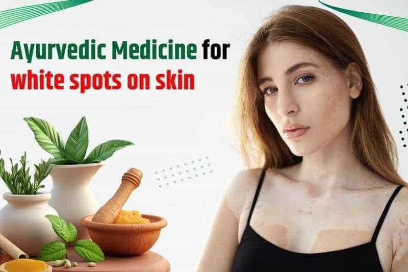 Ayurvedic Medicine for White Spots on Skin