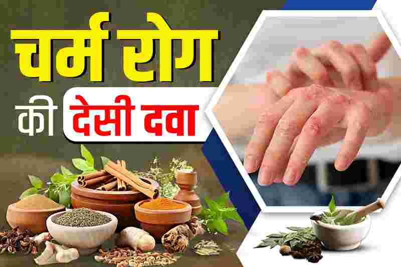 चर्म रोग की देसी दवा क्या है