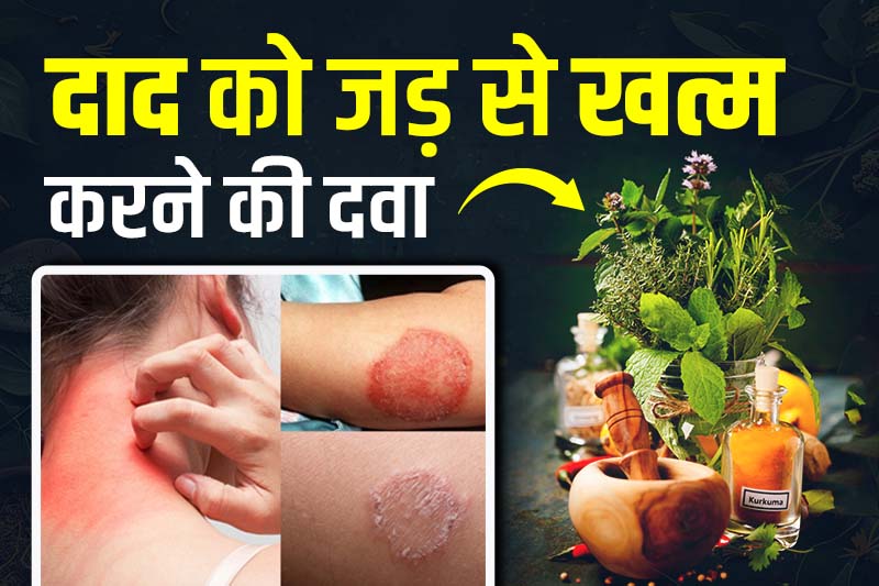 दाद को जड़ से खत्म करने की दवा,