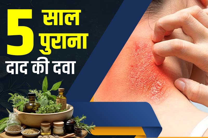 5 साल पुराना दाद की दवा