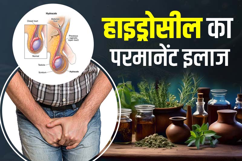 हाइड्रोसील का परमानेंट इलाज