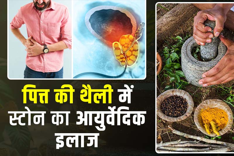पित्त की थैली में स्टोन का आयुर्वेदिक इलाज इन हिंदी