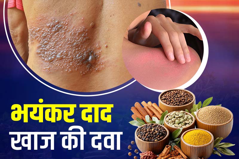 भयंकर दाद खाज की दवा
