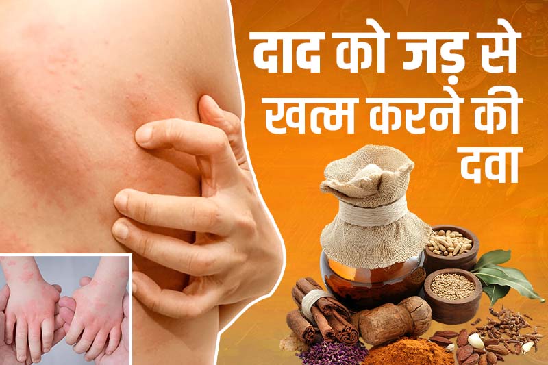 दाद को जड़ से खत्म करने की दवा