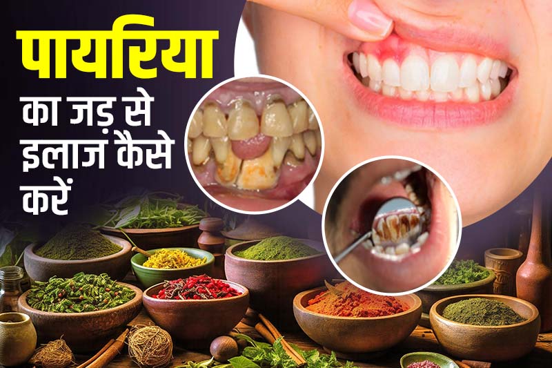 पायरिया को जड़ से इलाज कैसे करें
