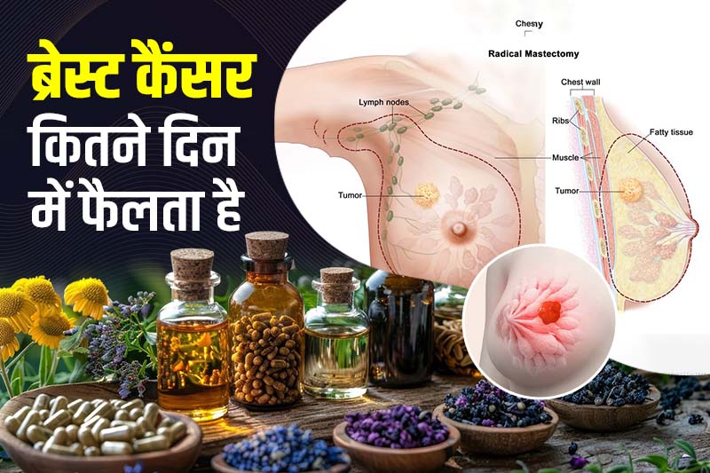 ब्रेस्ट कैंसर कितने दिन में फैलता है 