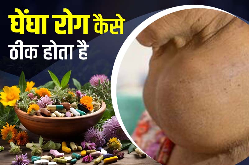 घेंघा रोग कैसे ठीक होता है