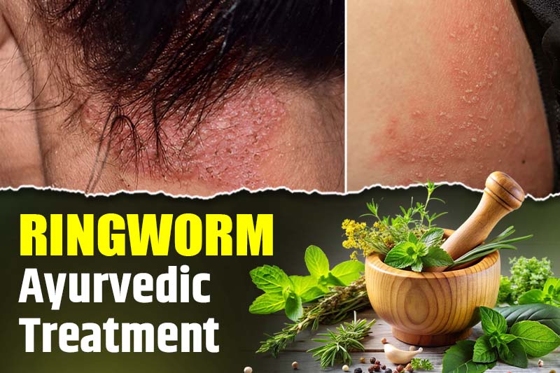 Ringworm Ayurvedic Treatment