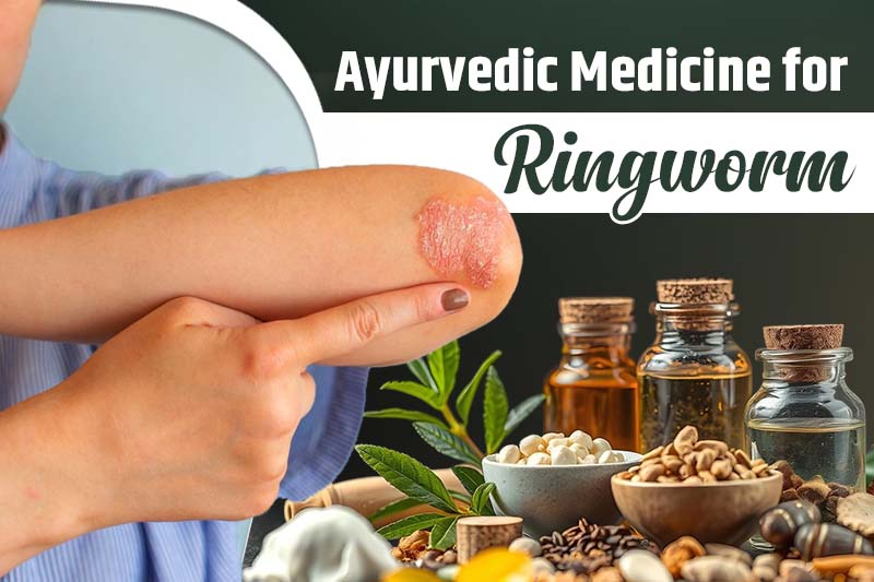 Ayurvedic Medicine for Ringworm
