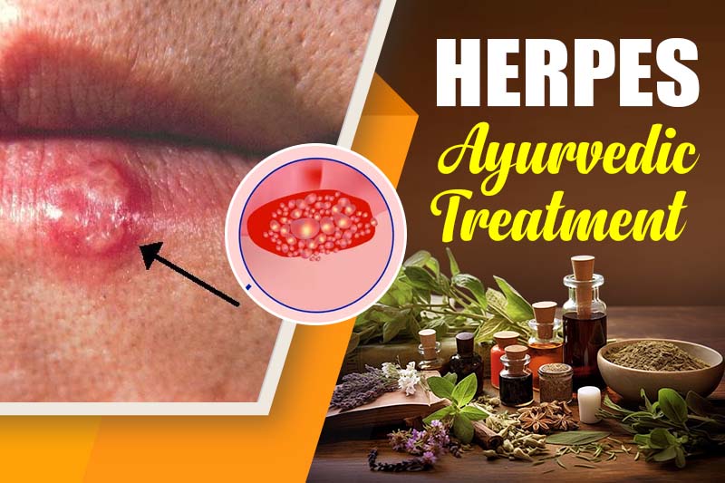 Herpes Ayurvedic Treatment