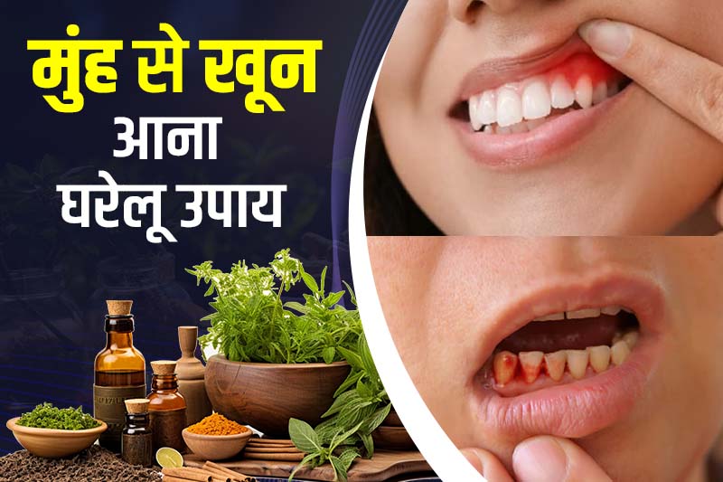 मुंह से खून आना घरेलू उपाय
