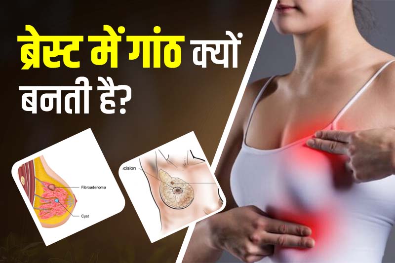 ब्रेस्ट में गांठ क्यों बनती है