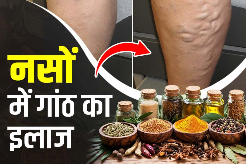 नसों में गांठ का इलाज