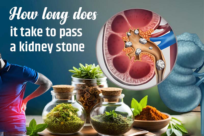 How Long Does It Take to Pass a Kidney Stone