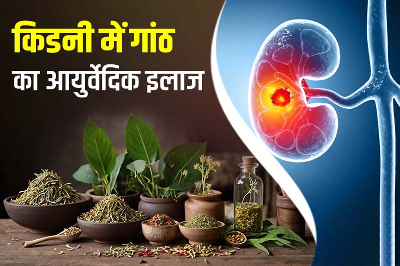 किडनी में गांठ का आयुर्वेदिक इलाज